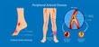 Peripheral artery disease ankle brachial index ABI test limb ischemia diagnosis vascular ABPI blockage