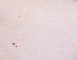 Two red moles on the patient s skin, hemangioma, angioneuromas, copy space