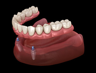 mandibular removable prosthesis all on 2 system supported by implants with ball attachments. medical