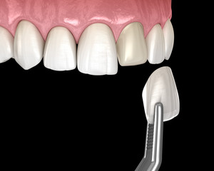 Veneer installation procedure over central incisor. Medically accurate tooth 3D illustration