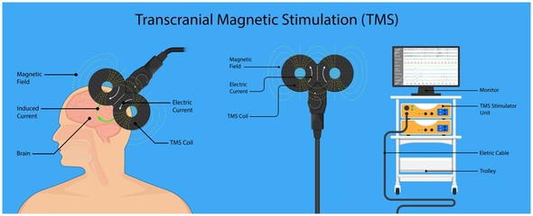 Transcranial magnetic stimulation TMS non invasive field obsessive compulsive disorder PTSD treat