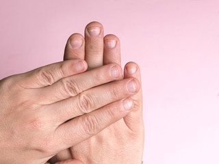 White spots on the nails of the male hand caused by a deficiency of calcium, zinc or poisoning by household chemicals on a pink background. This disease is called leukonychia.