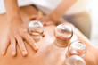 Detail of a woman therapist hands giving cupping treatment on back.