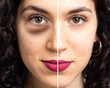 © Alessandro Grandini - Deep dark puffy under eye bags side by side comparison