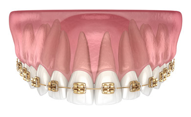 Golden braces tretament, macro view. Medically accurate dental 3D illustration