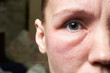© Konstiantyn Zapylaie - Swollen face of a woman under the eyes, swelling. An allergic reaction to drugs, cosmetics.
