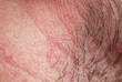  skin texture of the neck and chin of a young man covered with hair and beard bristles and irritation and scales