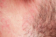  skin texture of the neck and cheeks of a young man covered with hair and beard bristles and irritation and scales