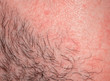  texture of irritated reddened male neck skin covered with hair and bristles