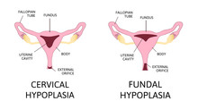 Uterine Hypoplasia, Naive Uterus Or Infantile Uterus.