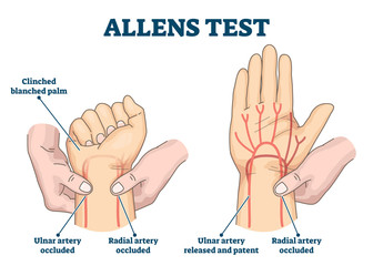 Poster - Allens test vector illustration. Physical arterial blood examination scheme