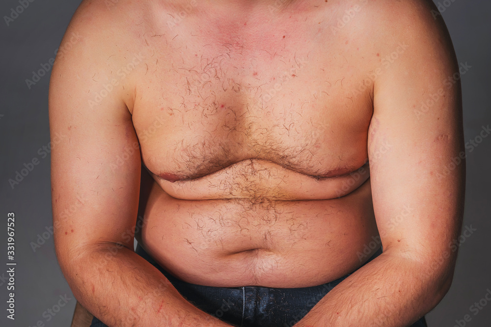 Heavy Torso Overweight male torso. Naked torso of a man. Hair increased vegetation ...