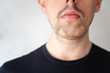 Close up of alopecia areata on a man's beard