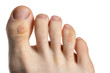 Foot of caucasian man with skin diseases. Callus corn on big toe, rare 