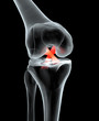 Painful knee joint with highlighted anterior and posterior cruciate ligament, medically 3D illustration
