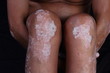 skin diseases - psoriasis on the legs