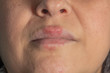 © Victor Mulero - Allergic reaction to metal on the lips of a middle-aged white woman