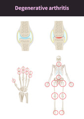 Wall Mural - medical illustration for explain diseases