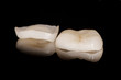 Teilkrone - Zahnkrone - Veneer aus Vollkeramik zum Kleben bei Bruxismus. Zahnfarbene Arbeit aus dem Dentallabor.