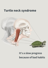 Turtle neck syndrome illust