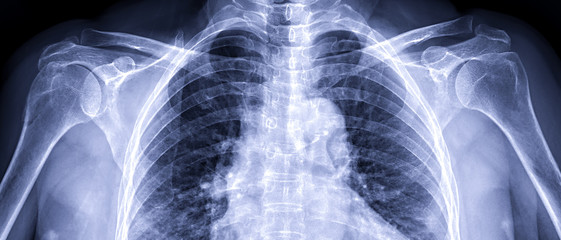 Poster - x-ray shoulder joint shoulder transaxillary view for diagnosis fracture of shoulder joint.