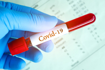 Blood samples and blood test results of the disease Coronavirus Covid 19.New epidemic prevention conce