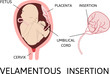 Velamentous insertion of umbilical cord. insertion site varies from the center