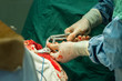 Close-up of the hands of a surgeon using ticks to break a skull during a head operation ..