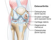 Osteoarthritis of the knee, medical accurate illustration
