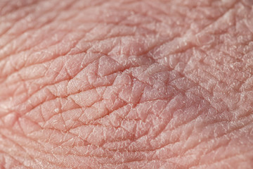 background with the texture of pink rough unhealthy weathered human skin covered with deep wrinkles and dry scales and cracks