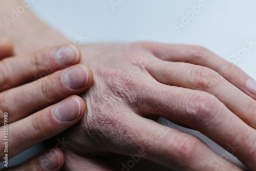 Man With Sick Hands Dry Flaky Skin On His Hand With Vulgar Psoriasis Eczema And Other Skin Diseases Such As Fungus Plaque Rash And Blemishes Autoimmune Genetic Disease Buy This Stock