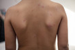 © Mladen - Period of smallpox.