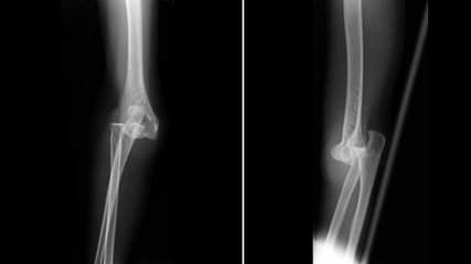 Wall Mural - Film X ray elbow radiograph show elbow dislocation. Joint dislocation injury from physical assault. The patient has elbow pain and limit joint motion. Medical imaging and scan investigation concept.