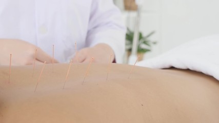 Wall Mural - Hands of therapist doing acupuncture at patient back ,Chinese alternative medicine concept.