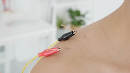 Wall Mural - Asian woman receiving shoulder acupuncture with electrical stimulator at clinic,Chinese alternative medicine concept.