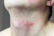 Skin irritation on male neck after shaving. Close-up photo.