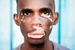 © Santi Nunez/Stocksy - Portrait of a brown skin man with vitiligo