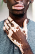 © Santi Nunez/Stocksy - Close up of a beautiful diverse person highlighting the contrast of his skin with vitiligo condition