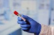 © Roman Tyukin - A hand of a physician in a blue disposable medical glove holding a positive coronavirus (COVID-19) blood test in the laboratory.