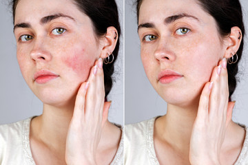 Portrait of a young caucasian woman with red and inflamed blood vessels on her cheeks and without them after treatment. Close up. Gray background. The concept of couperose. Before and after