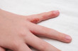 © ReaLiia - Child hand witn eczema, atopic dermatitis between fingers