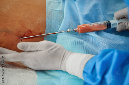 Fotomural Liposuction corrective plastic surgery for liposuction of fat deposits in the abdomen