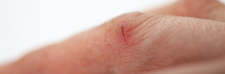 Close-up small wound on finger, dry skin hands