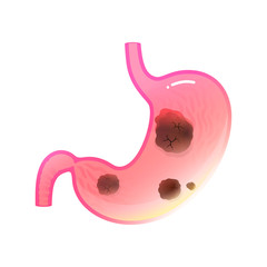 Sticker - Vector isolated illustration of stomach cancer 