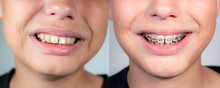 Close Up View Collage Photography Of Smiling Mouth Of Young White Kid With Overbite Teeth Before And After Fixing Metal Modern Braces Construction On Teeth. Shoot The Same Day.