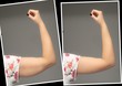 © Alessandro Grandini - Comparison before and after excess skin removal under arm, results of brachioplasty surgery. Young caucasian female hand against grey background. Health care concept...