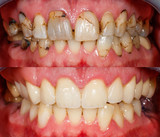 Fototapeta  - Teeth before and after treatment