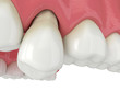 3d render of jaw with tooth protruding from the gums