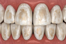 Tooth Demineralization, Removal Of Minerals From Hard Tissues: Enamel, Dentine, And Cementu. Medically Accurate 3D Illustration.