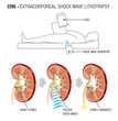 Extracorporeal shock wave lithotripsy (ESWL) for kidney stones. shock waves to break a kidney stone